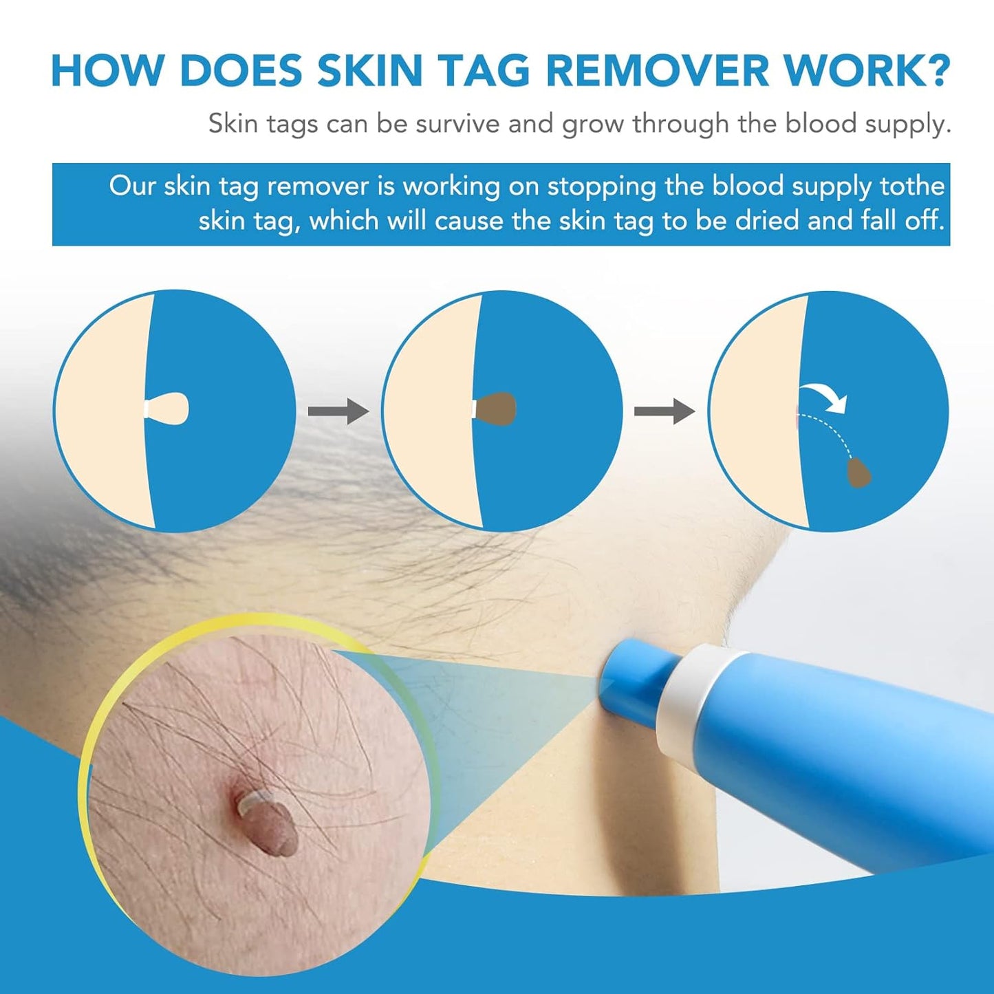 Skin Tag Remover Kit 2 In 1 For Micro To Large (2 Mm - 8 Mm 1 Set)